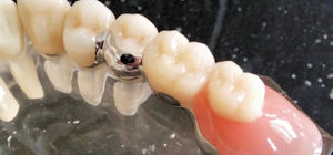 Geschiebe Prothesen als herausnehmbaren Zahnersatz