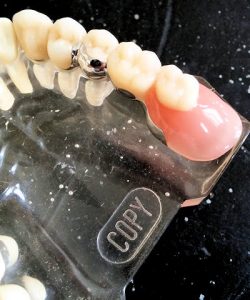 Geschiebe Prothesen RAB Zahntechnik Labor GmbH