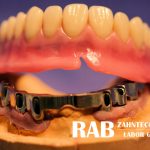 Dental-Arbeiten von RAB Zahntechnik Dentallabor Berlin