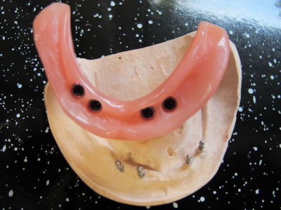 3M ESPE MDI Mini-Dental-Implantate