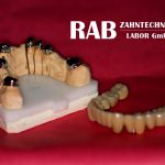 Dental-Arbeiten von RAB Zahntechnik Dentallabor Berlin