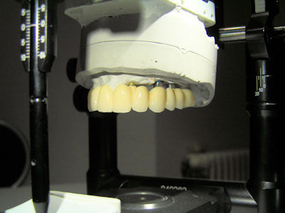 Implantatprothetik von Einzelzahnersatz über implantatgetragene Kronenblöcke/Brücken bis zur Befestigung und Abstützung von abnehmbaren Zahnersatz auf Implantaten